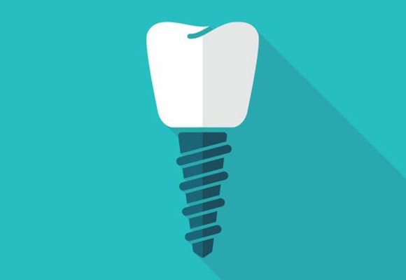 What to Expect When Getting a Dental Implant to Replace a Missing Tooth