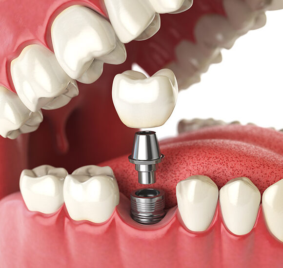 Will I Need a Bone Graft for Dental Implants